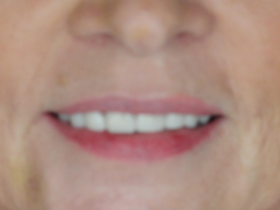 Smile Makeovers, actual cases of our dentists, no special lighting or editing Case 13 - After