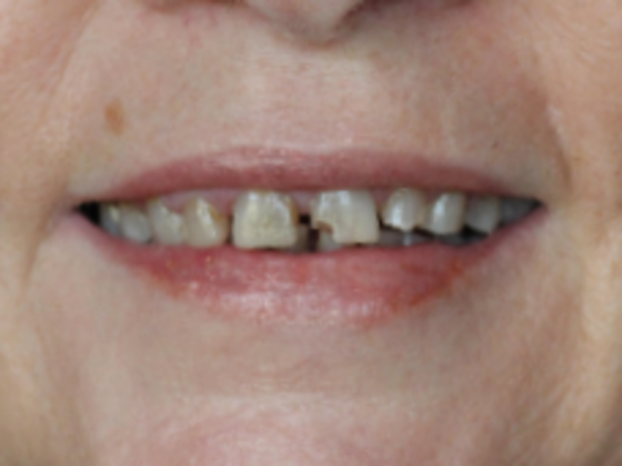 Smile Makeovers, actual cases of our dentists, no special lighting or editing Case 13 - Before
