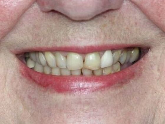 Smile Makeovers, actual cases of our dentists, no special lighting or editing Case 14 - Before