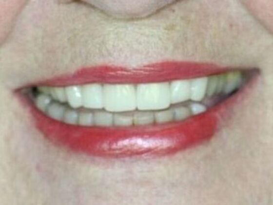 Smile Makeovers, actual cases of our dentists, no special lighting or editing Case 14 - After