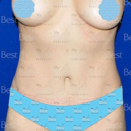 Tummy Tuck Skin and muscles affected by pregnancy - After