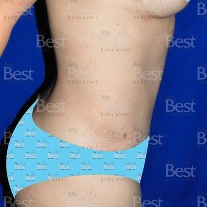 Tummy Tuck: Skin and muscles affected by pregnancy - After