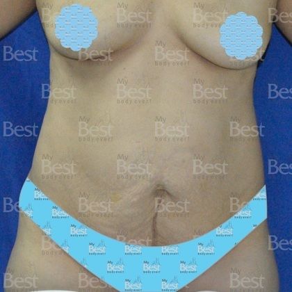 Tummy Tuck Skin and muscles affected by pregnancy - Before