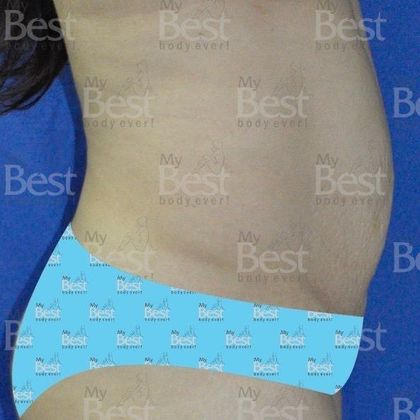 Tummy Tuck: Skin and muscles affected by pregnancy - Before