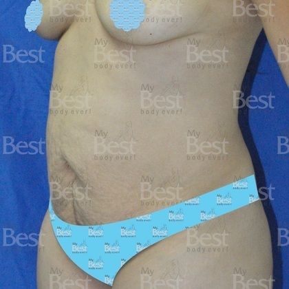 Tummy Tuck: Skin and muscles affected by pregnancy - Before