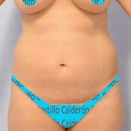 Tummy Tuck If you want to improve your body, start with the abdomen - Before