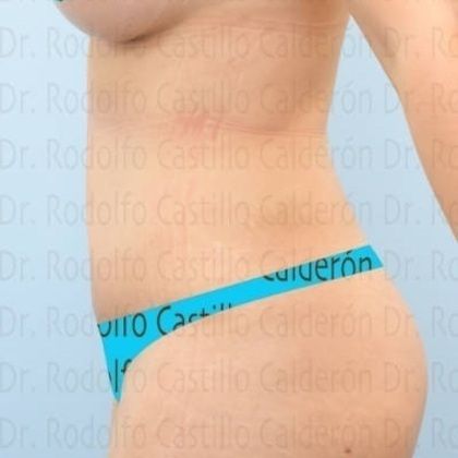 Tummy Tuck: If you want to improve your body, start with the abdomen - After
