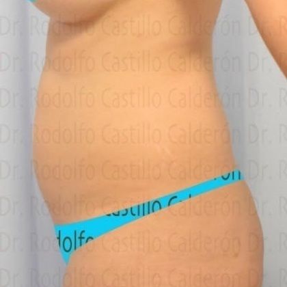 Tummy Tuck: If you want to improve your body, start with the abdomen - Before