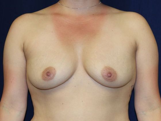 Breast Augmentation*: Case 64 - Before