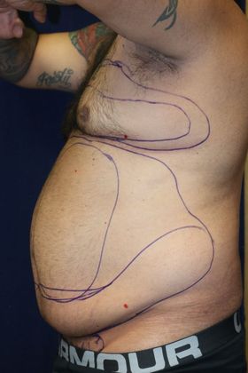 Liposuction & Safe Lipo: Case 43 - Before