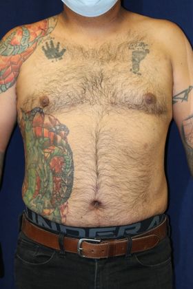 Liposuction & Safe Lipo: Case 43 - After