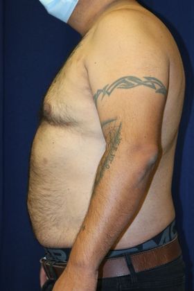 Liposuction & Safe Lipo: Case 43 - After