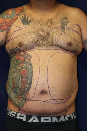 Liposuction & Safe Lipo: Case 43 - Before