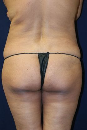 🥇 Reno NV Butt Implants  Lake Tahoe Buttocks Plastic Surgeon