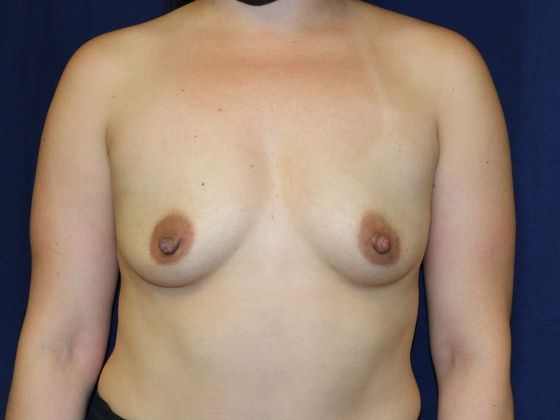 Breast Augmentation*: Case 65 - Before