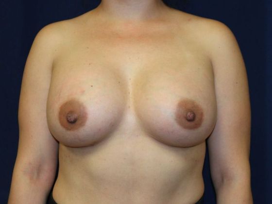 Breast Augmentation*: Case 65 - After
