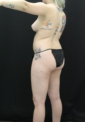 Liposuction: Case 15 - Before