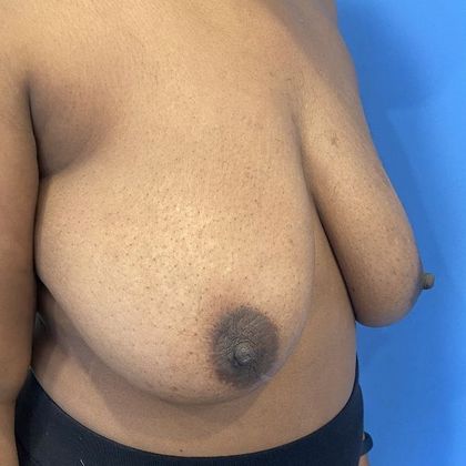 Breast Lift: Case 14 Breast Lift, Darien - Before
