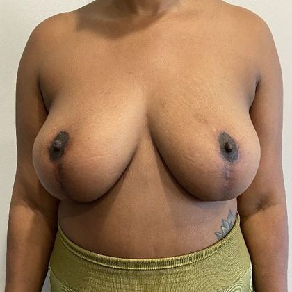 Breast Lift: Case 14 Breast Lift, Darien - After