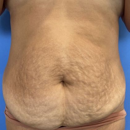 Tummy Tuck: Case 25 Tummy Tuck Stamford, CT - Before