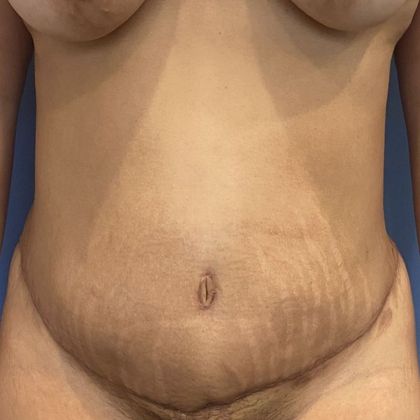 Tummy Tuck: Case 25 Tummy Tuck Stamford, CT - After