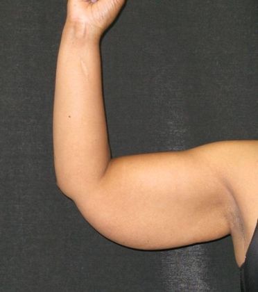 Brachioplasty (Arm Lift) Case 1 - Before