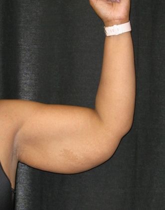 Brachioplasty (Arm Lift): Case 1 - Before