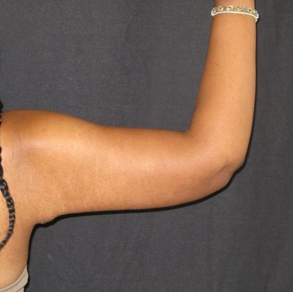 Brachioplasty (Arm Lift): Case 1 - After