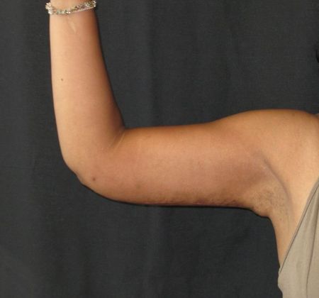 Brachioplasty (Arm Lift) Case 1 - After