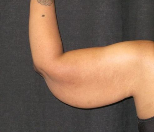 Brachioplasty (Arm Lift): Case 1 - Before
