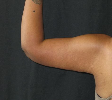 Brachioplasty (Arm Lift): Case 1 - After