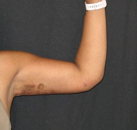 Brachioplasty (Arm Lift): Case 1 - After