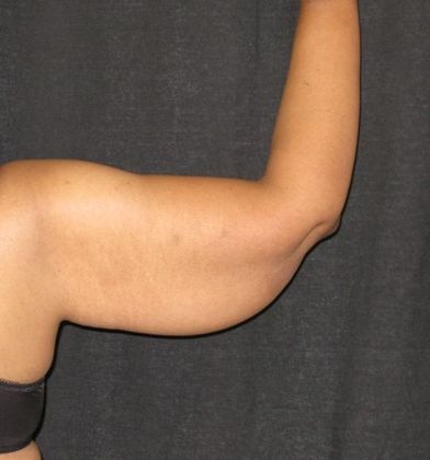 Brachioplasty (Arm Lift): Case 1 - Before