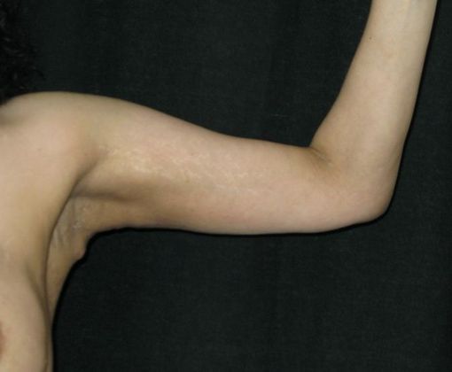 Brachioplasty (Arm Lift): Case 2 - After