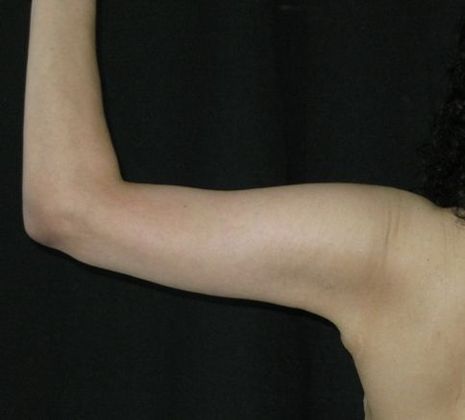 Brachioplasty (Arm Lift): Case 2 - After