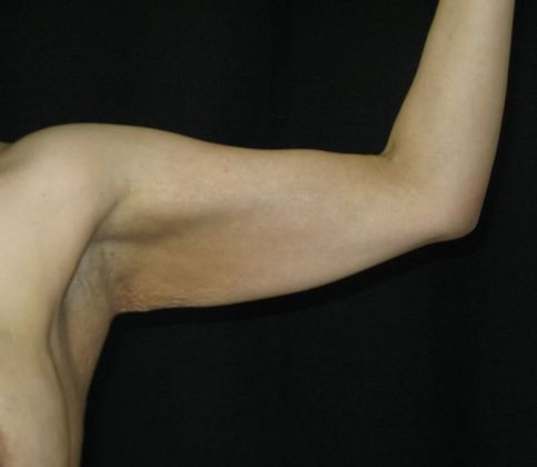 Brachioplasty (Arm Lift): Case 2 - Before