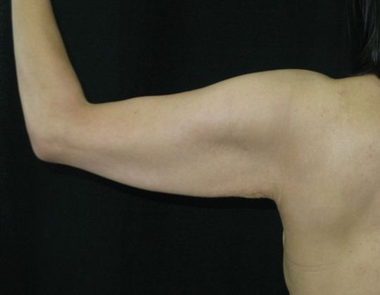 Brachioplasty (Arm Lift): Case 2 - Before