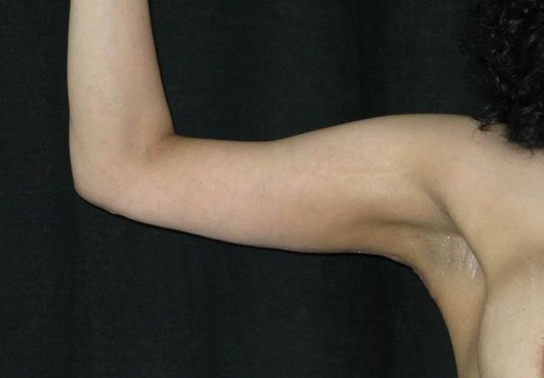 Brachioplasty (Arm Lift): Case 2 - After