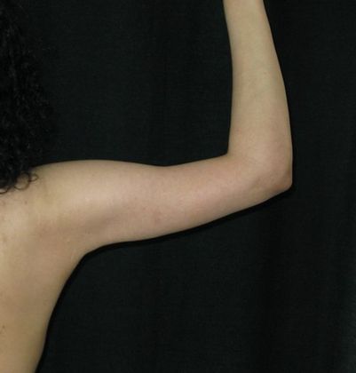 Brachioplasty (Arm Lift): Case 2 - After