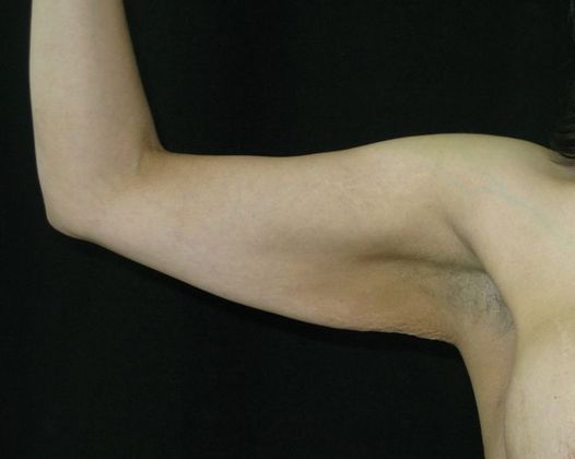 Brachioplasty (Arm Lift): Case 2 - Before