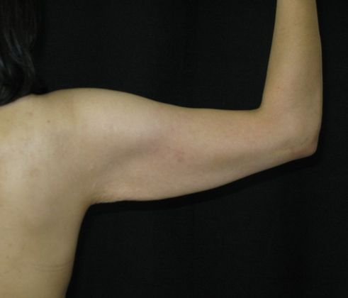 Brachioplasty (Arm Lift): Case 2 - Before