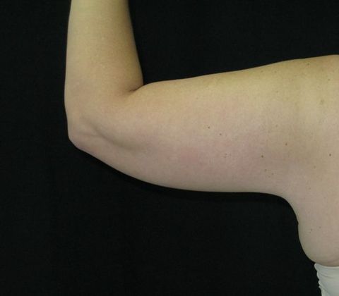 Brachioplasty (Arm Lift): Case 3 - After