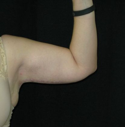 Brachioplasty (Arm Lift): Case 3 - After