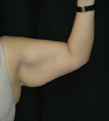 Brachioplasty (Arm Lift): Case 3 - Before