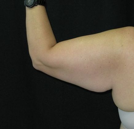 Brachioplasty (Arm Lift): Case 3 - Before