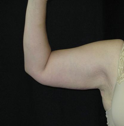 Brachioplasty (Arm Lift) Case 3 - After