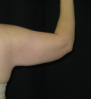 Brachioplasty (Arm Lift): Case 3 - After