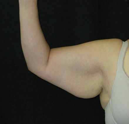 Brachioplasty (Arm Lift) Case 3 - Before
