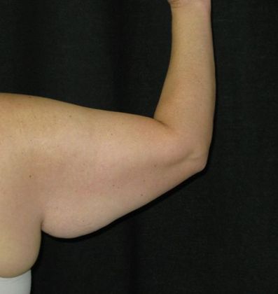Brachioplasty (Arm Lift): Case 3 - Before