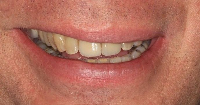 Porcelain Crowns Case 18 - Before